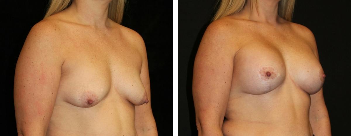 Mastopexy Augmentation Before & After Gallery - Patient 207861 - Image 2