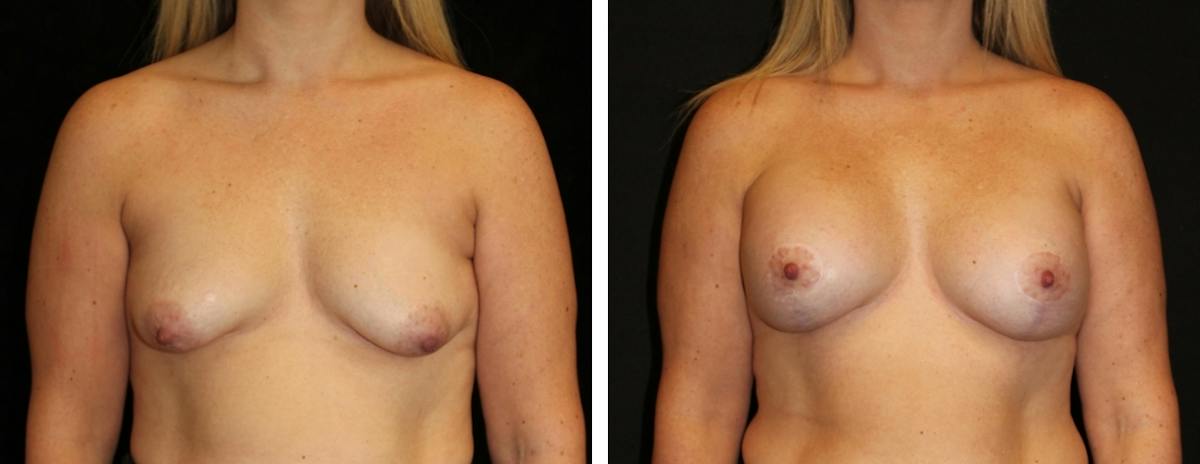 Mastopexy Augmentation Before & After Gallery - Patient 207861 - Image 1