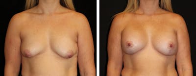 Mastopexy Augmentation Before & After Gallery - Patient 207861 - Image 1