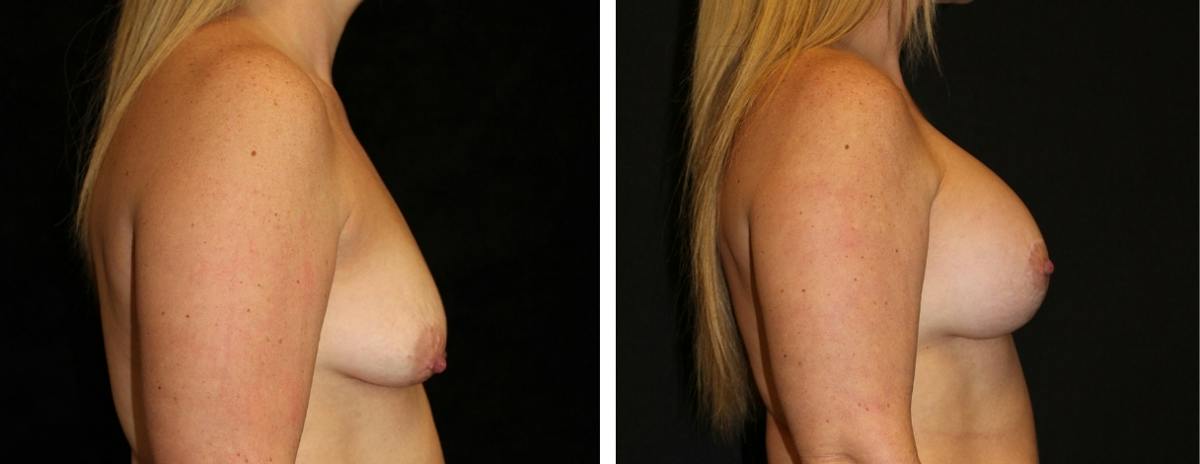 Mastopexy Augmentation Before & After Gallery - Patient 207861 - Image 3