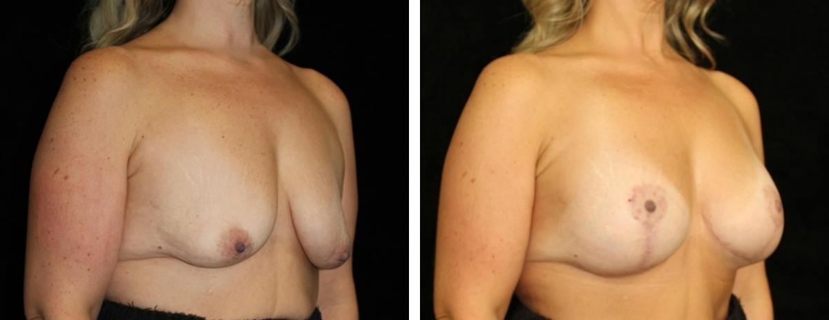 Mastopexy Augmentation Before & After Gallery - Patient 628481 - Image 2