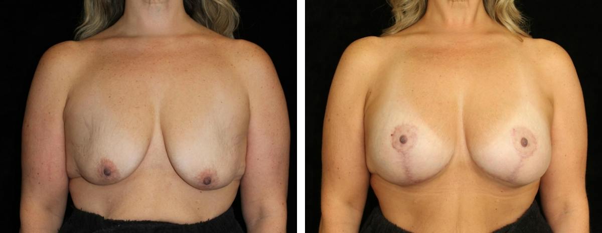 Mastopexy Augmentation Before & After Gallery - Patient 628481 - Image 1