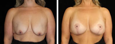 Mastopexy Augmentation Before & After Gallery - Patient 628481 - Image 1