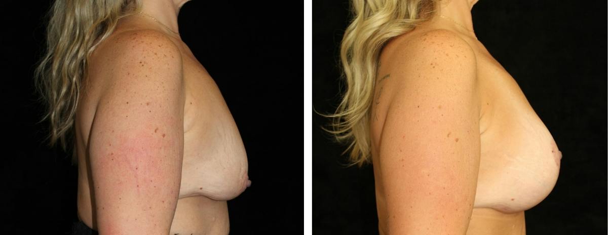 Mastopexy Augmentation Before & After Gallery - Patient 628481 - Image 3