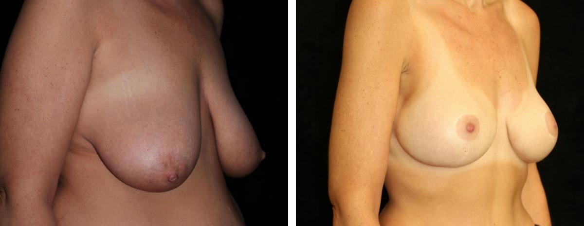 Mastopexy Augmentation Before & After Gallery - Patient 312459 - Image 2