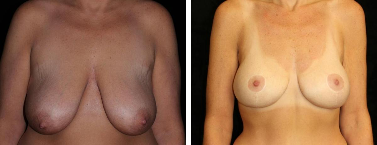 Mastopexy Augmentation Before & After Gallery - Patient 312459 - Image 1