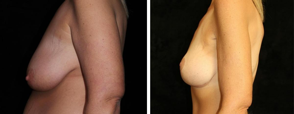 Mastopexy Augmentation Before & After Gallery - Patient 312459 - Image 3