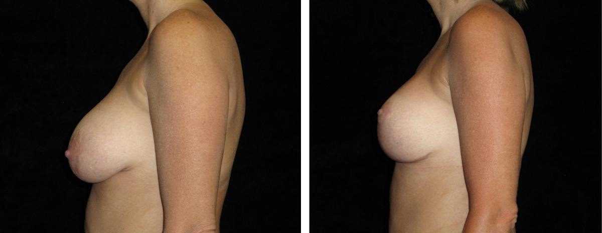 Mastopexy Augmentation Before & After Gallery - Patient 160563 - Image 3