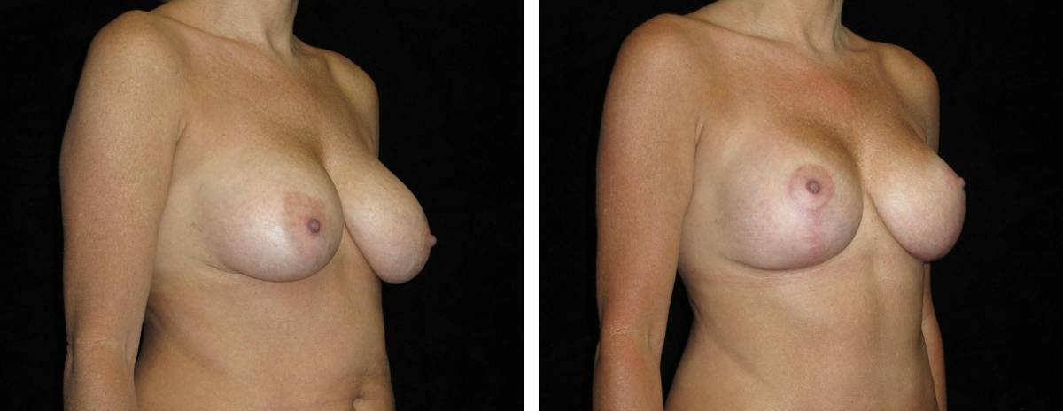 Mastopexy Augmentation Before & After Gallery - Patient 160563 - Image 2