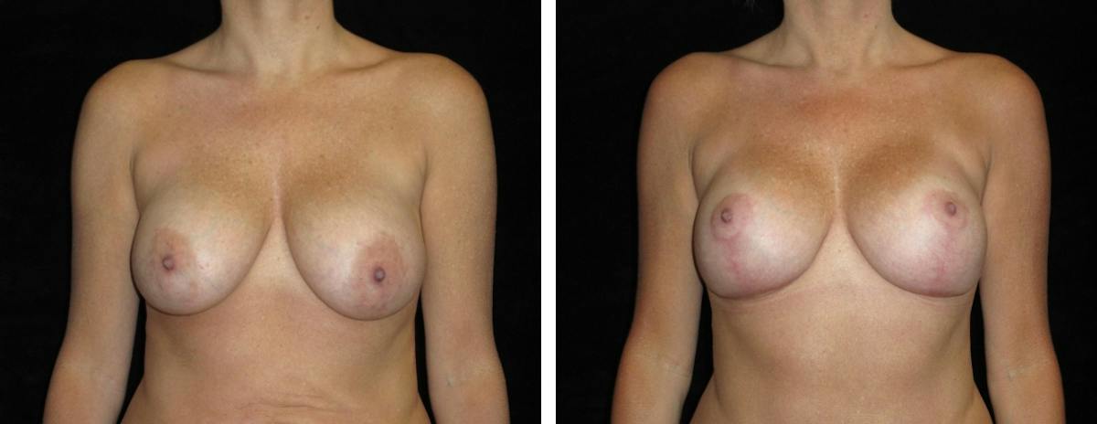 Mastopexy Augmentation Before & After Gallery - Patient 160563 - Image 1