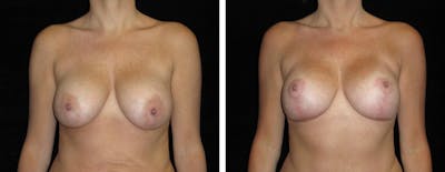 Mastopexy Augmentation Before & After Gallery - Patient 160563 - Image 1
