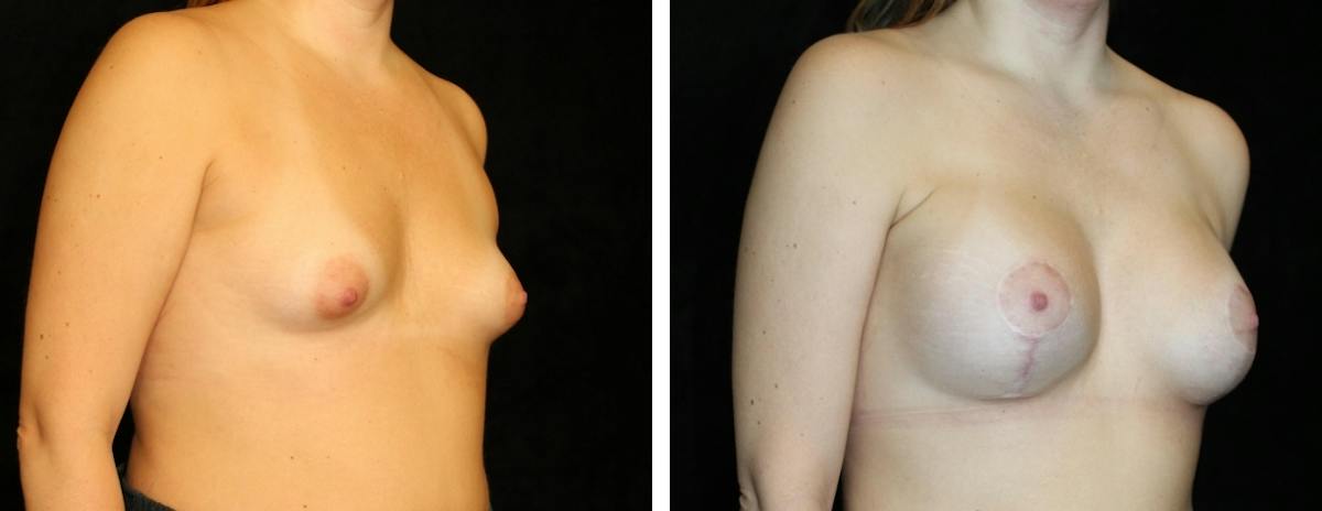 Mastopexy Augmentation Before & After Gallery - Patient 302605 - Image 2