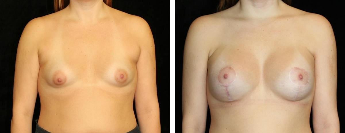 Mastopexy Augmentation Before & After Gallery - Patient 302605 - Image 1