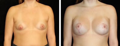 Mastopexy Augmentation Before & After Gallery - Patient 302605 - Image 1