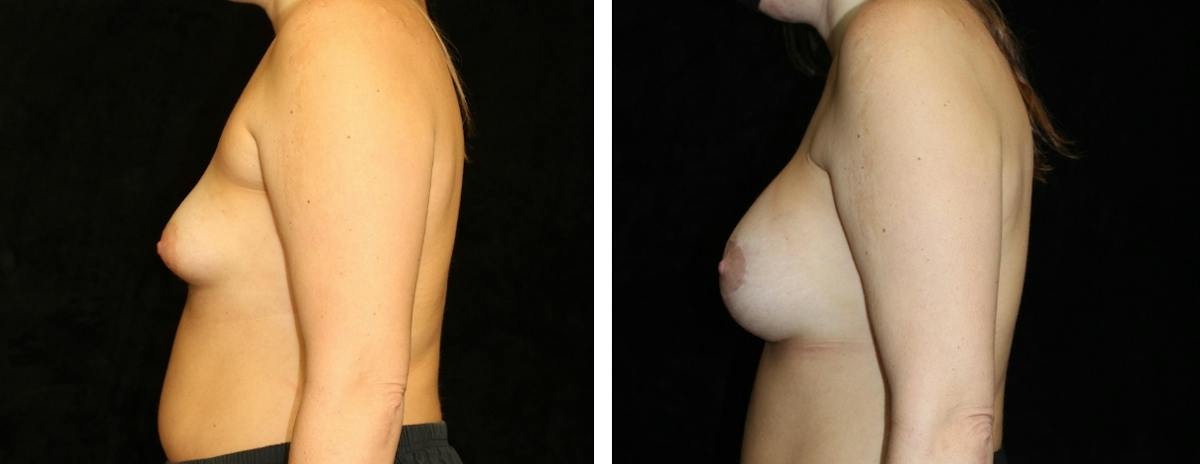 Mastopexy Augmentation Before & After Gallery - Patient 302605 - Image 3