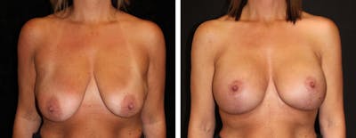Mastopexy Augmentation Before & After Gallery - Patient 285254 - Image 1