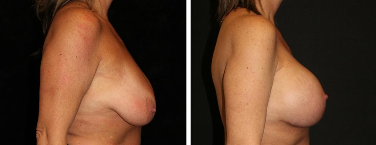 Mastopexy Augmentation Before & After Gallery - Patient 285254 - Image 3