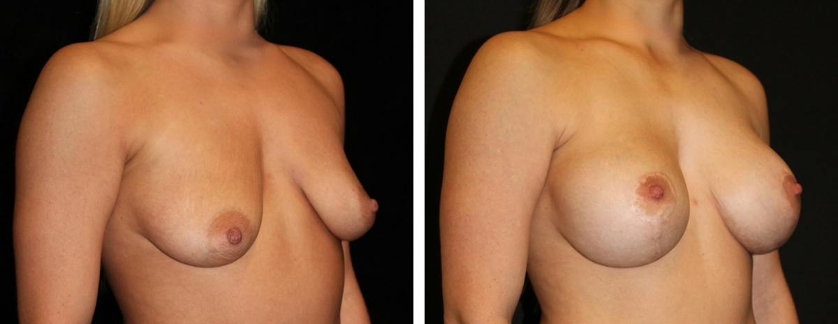 Mastopexy Augmentation Before & After Gallery - Patient 430337 - Image 2
