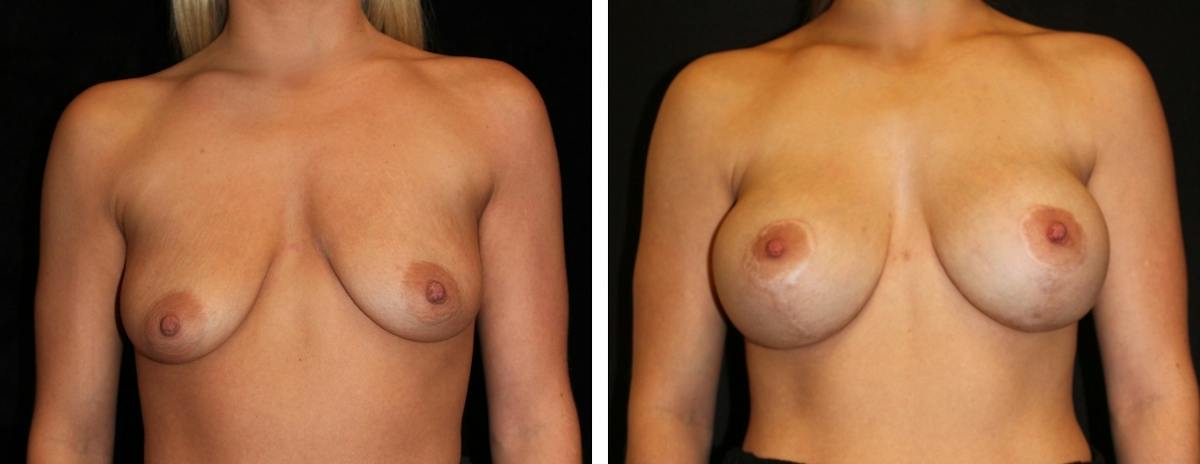 Mastopexy Augmentation Before & After Gallery - Patient 430337 - Image 1