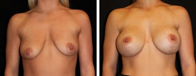 Mastopexy Augmentation Before & After Gallery - Patient 430337 - Image 1