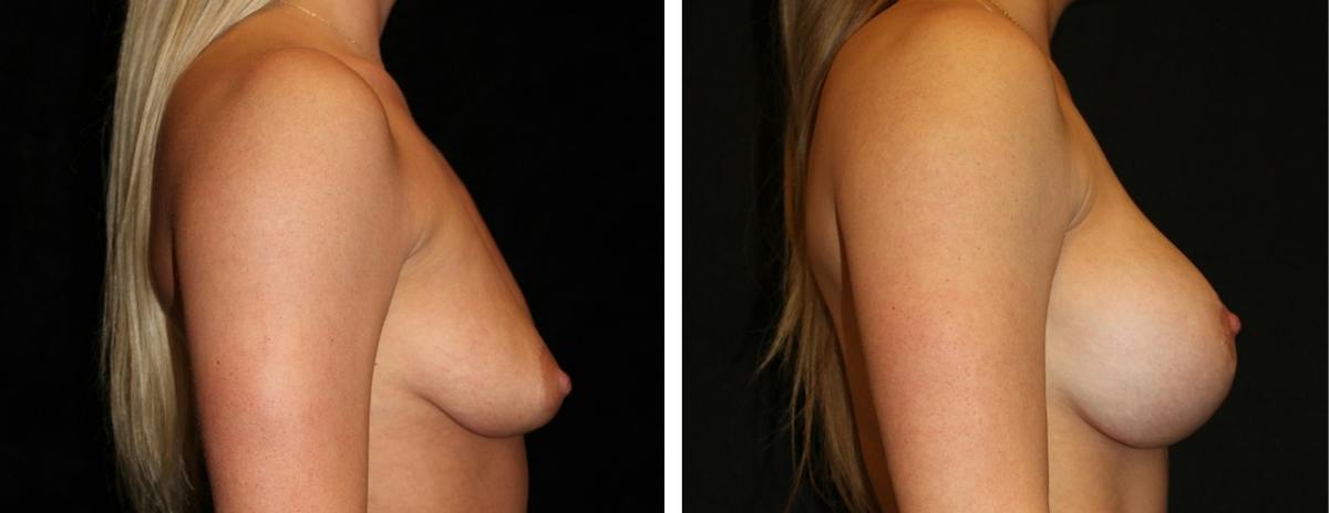 Mastopexy Augmentation Before & After Gallery - Patient 430337 - Image 3