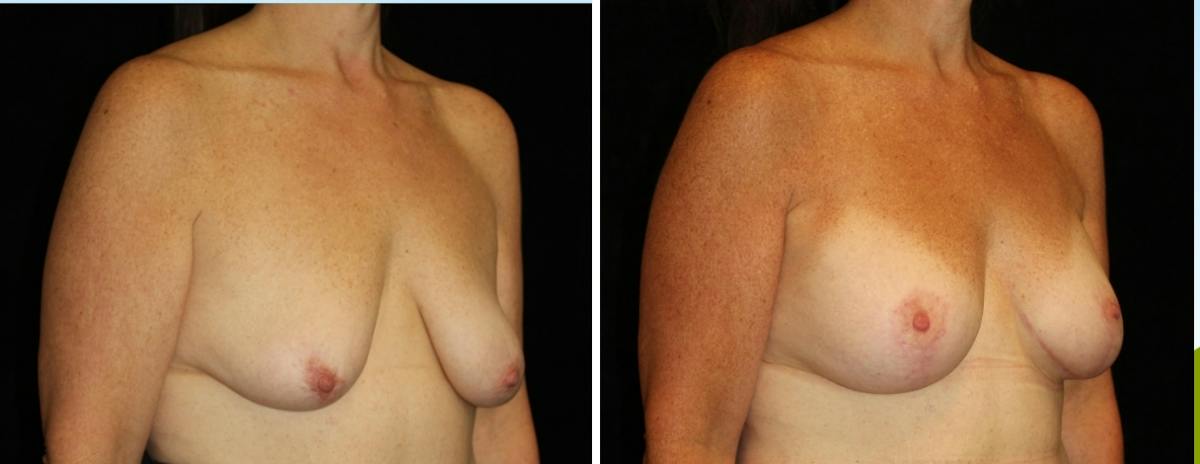 Mastopexy Augmentation Before & After Gallery - Patient 137286 - Image 2