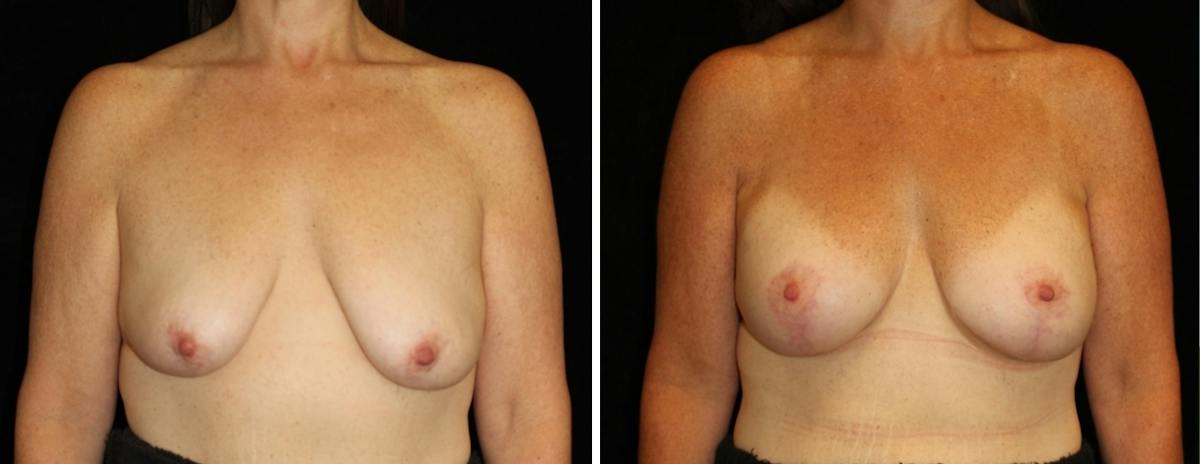 Mastopexy Augmentation Before & After Gallery - Patient 137286 - Image 1