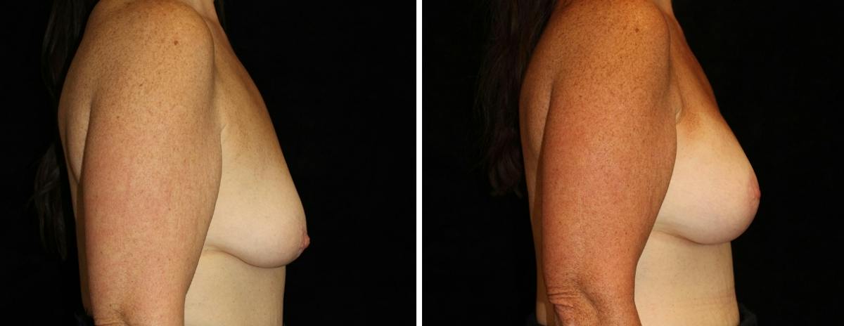 Mastopexy Augmentation Before & After Gallery - Patient 137286 - Image 3