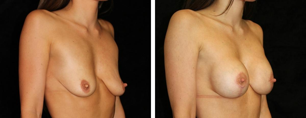 Mastopexy Augmentation Before & After Gallery - Patient 363648 - Image 2