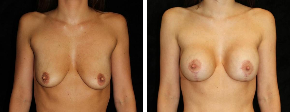 Mastopexy Augmentation Before & After Gallery - Patient 363648 - Image 1