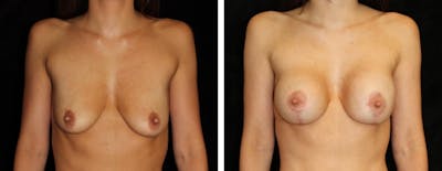 Mastopexy Augmentation Before & After Gallery - Patient 363648 - Image 1