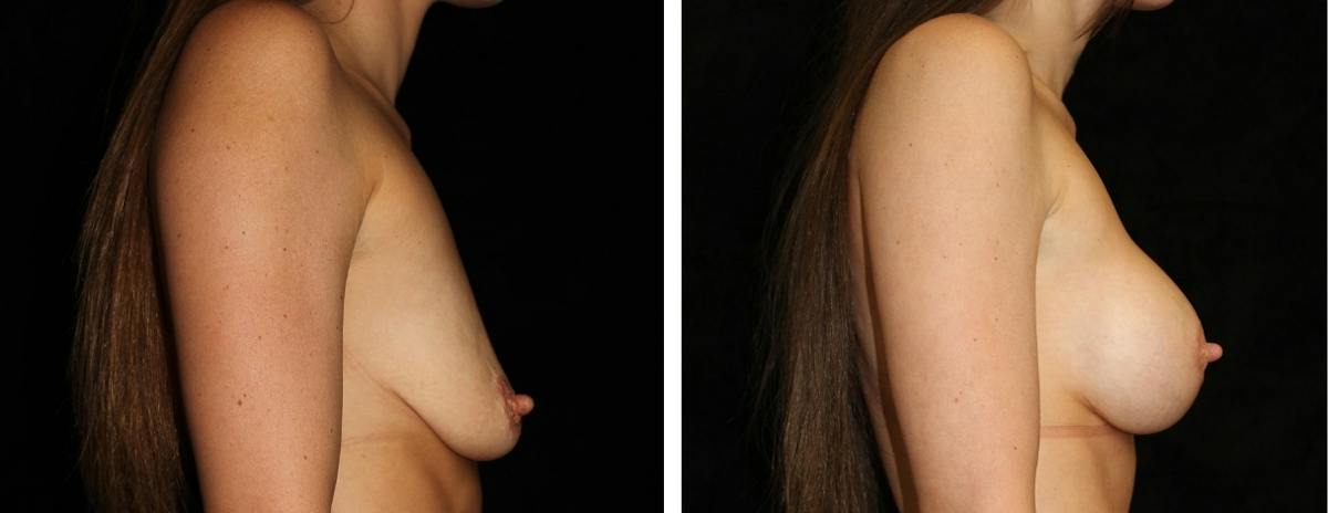 Mastopexy Augmentation Before & After Gallery - Patient 363648 - Image 3