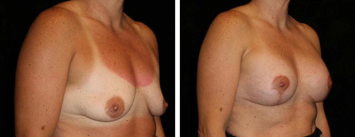 Mastopexy Augmentation Before & After Gallery - Patient 367231 - Image 2
