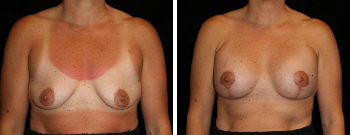 Mastopexy Augmentation Before & After Gallery - Patient 367231 - Image 1