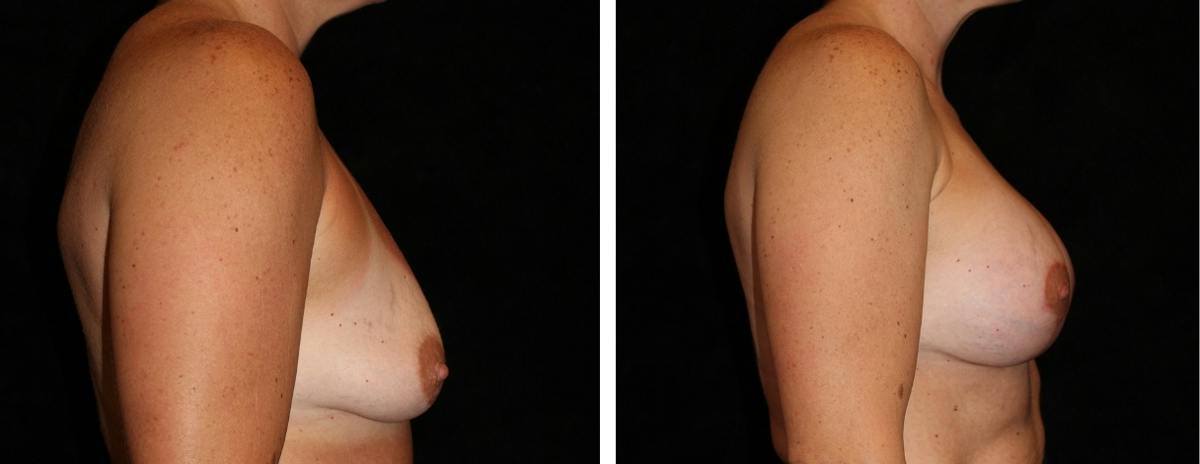 Mastopexy Augmentation Before & After Gallery - Patient 367231 - Image 3