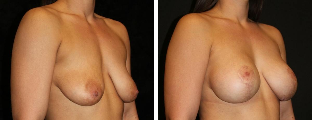 Mastopexy Augmentation Before & After Gallery - Patient 881281 - Image 2