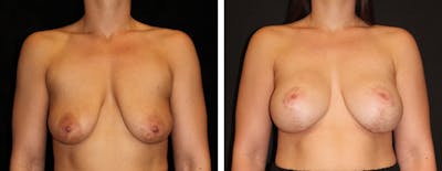 Mastopexy Augmentation Before & After Gallery - Patient 881281 - Image 1