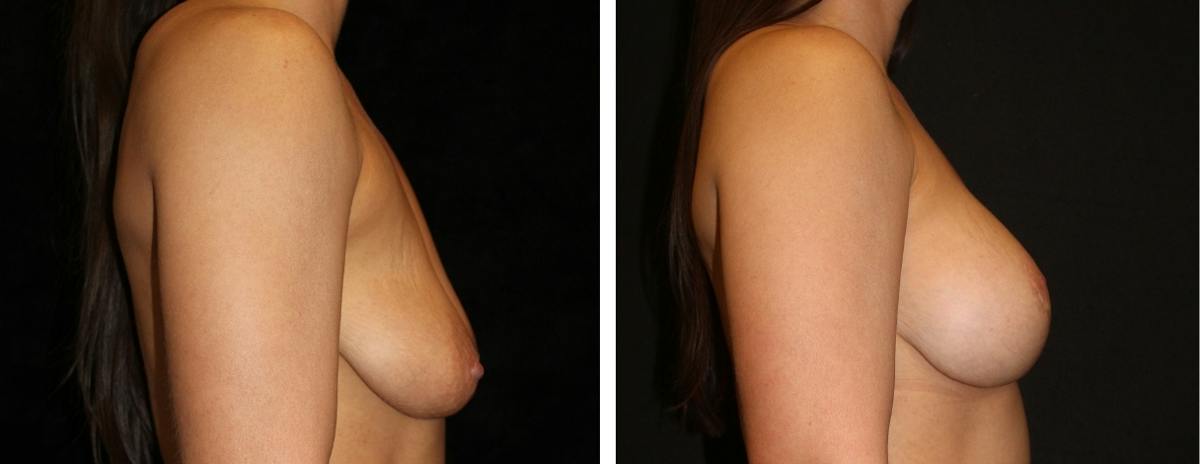 Mastopexy Augmentation Before & After Gallery - Patient 881281 - Image 3