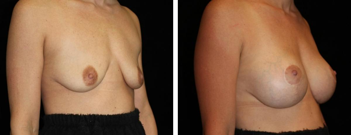Mastopexy Augmentation Before & After Gallery - Patient 272455 - Image 2