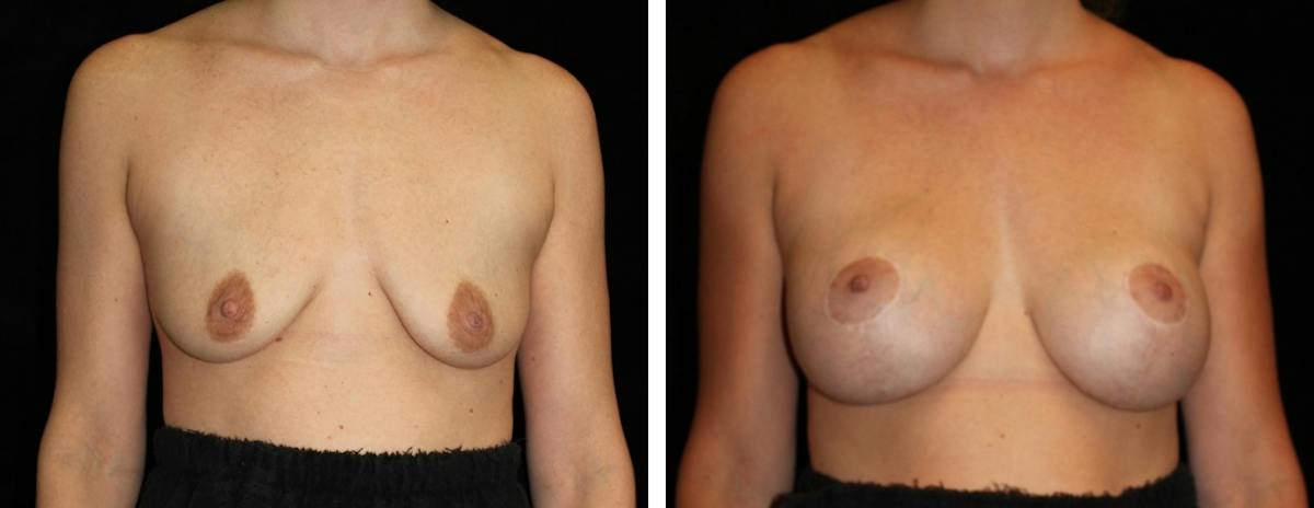 Mastopexy Augmentation Before & After Gallery - Patient 272455 - Image 1