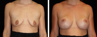 Mastopexy Augmentation Before & After Gallery - Patient 272455 - Image 1