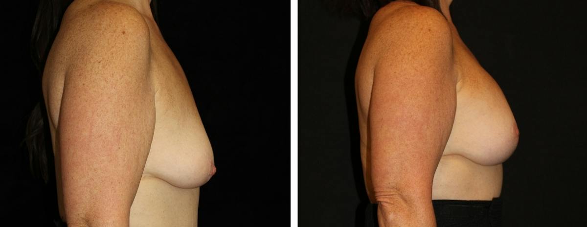Mastopexy Augmentation Before & After Gallery - Patient 272455 - Image 3