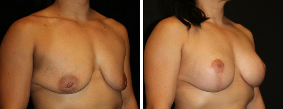 Mastopexy Augmentation Before & After Gallery - Patient 104745 - Image 2