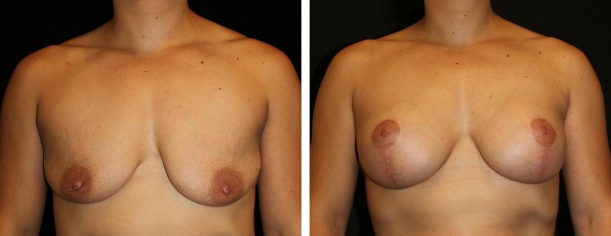 Mastopexy Augmentation Before & After Gallery - Patient 104745 - Image 1