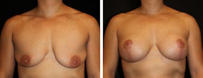 Mastopexy Augmentation Before & After Gallery - Patient 104745 - Image 1