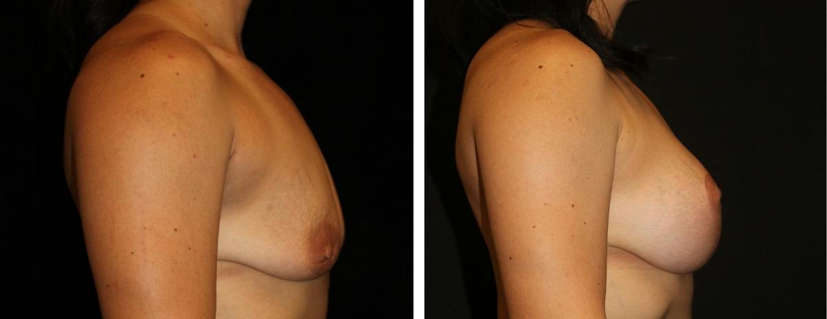 Mastopexy Augmentation Before & After Gallery - Patient 104745 - Image 3