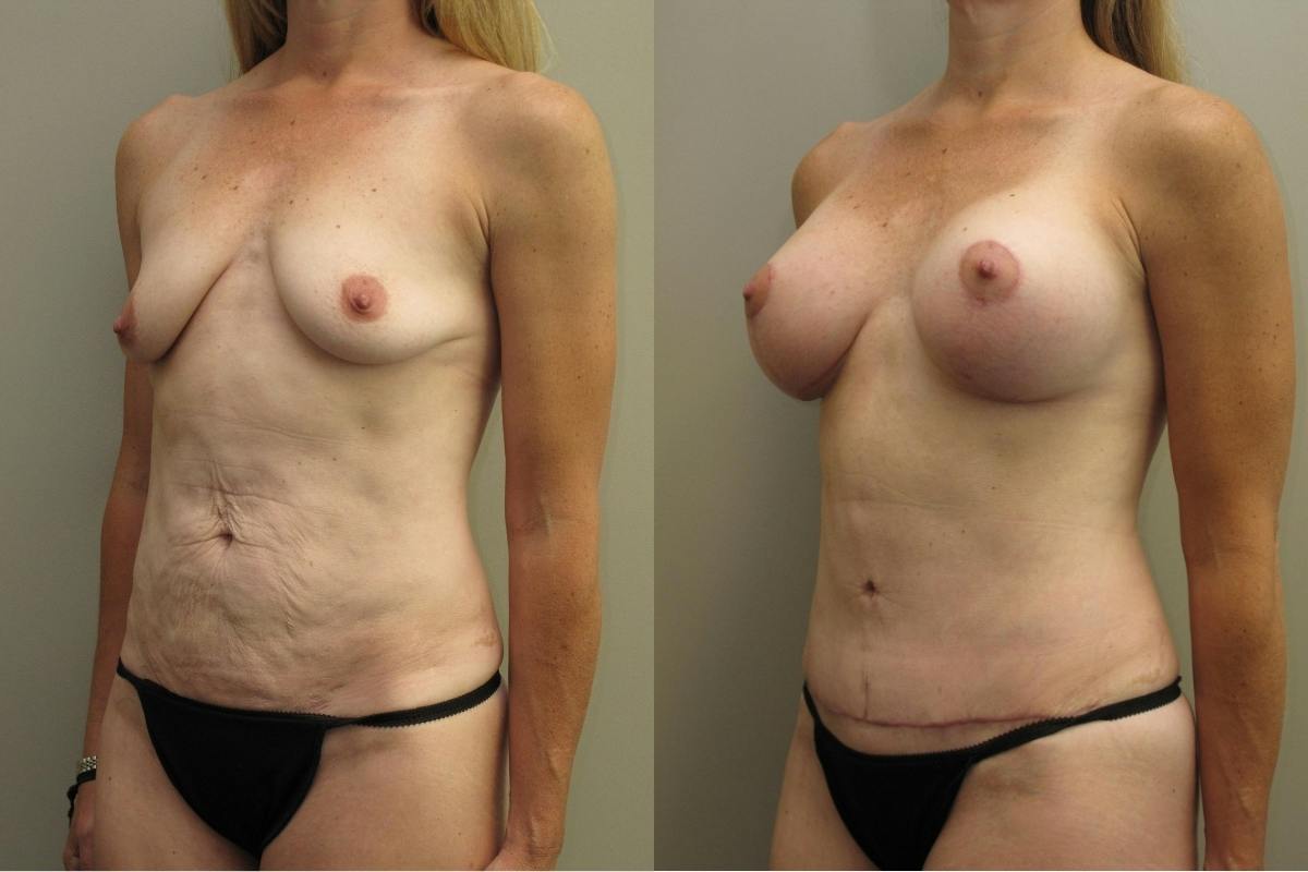 Mommy Makeover Before & After Gallery - Patient 450167 - Image 2