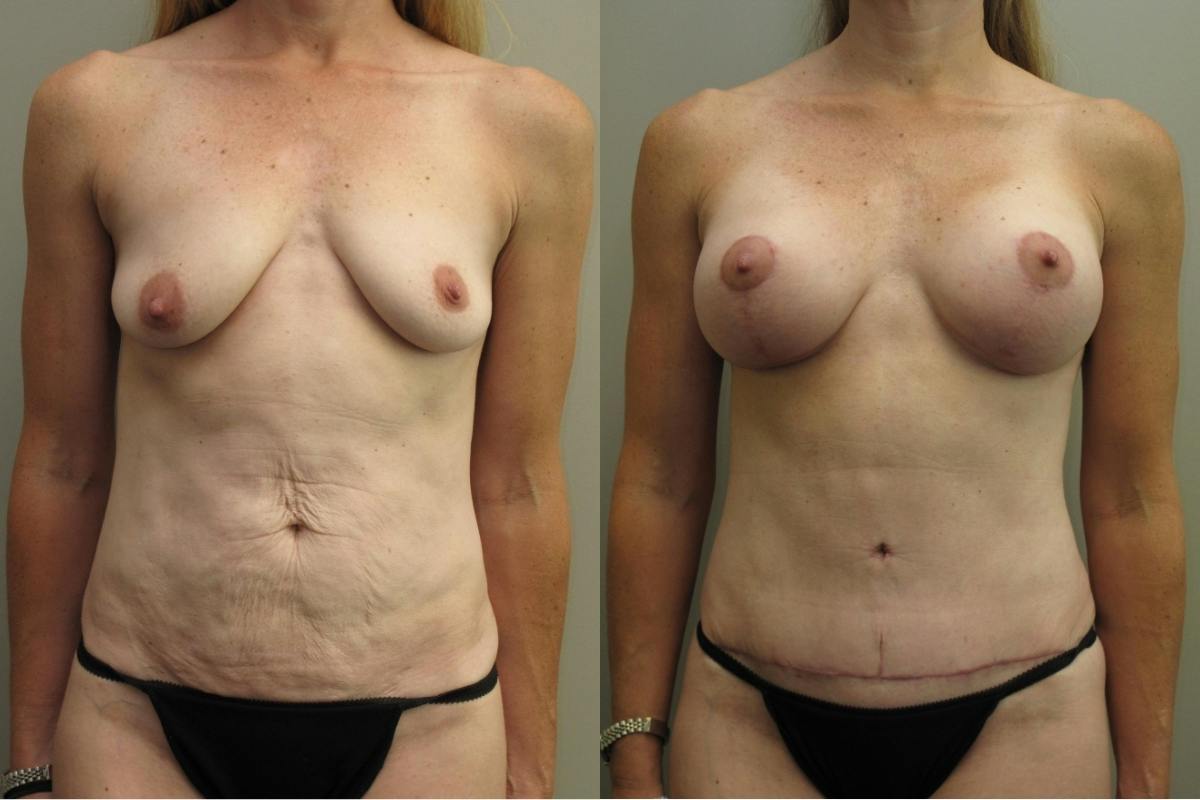 Mommy Makeover Before & After Gallery - Patient 450167 - Image 1
