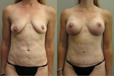 Mommy Makeover Before & After Gallery - Patient 450167 - Image 1