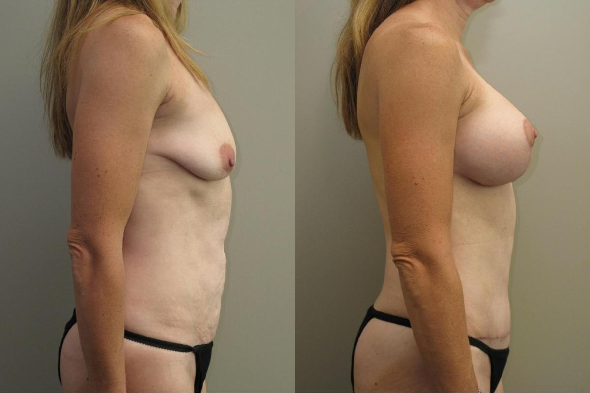 Mommy Makeover Before & After Gallery - Patient 450167 - Image 3